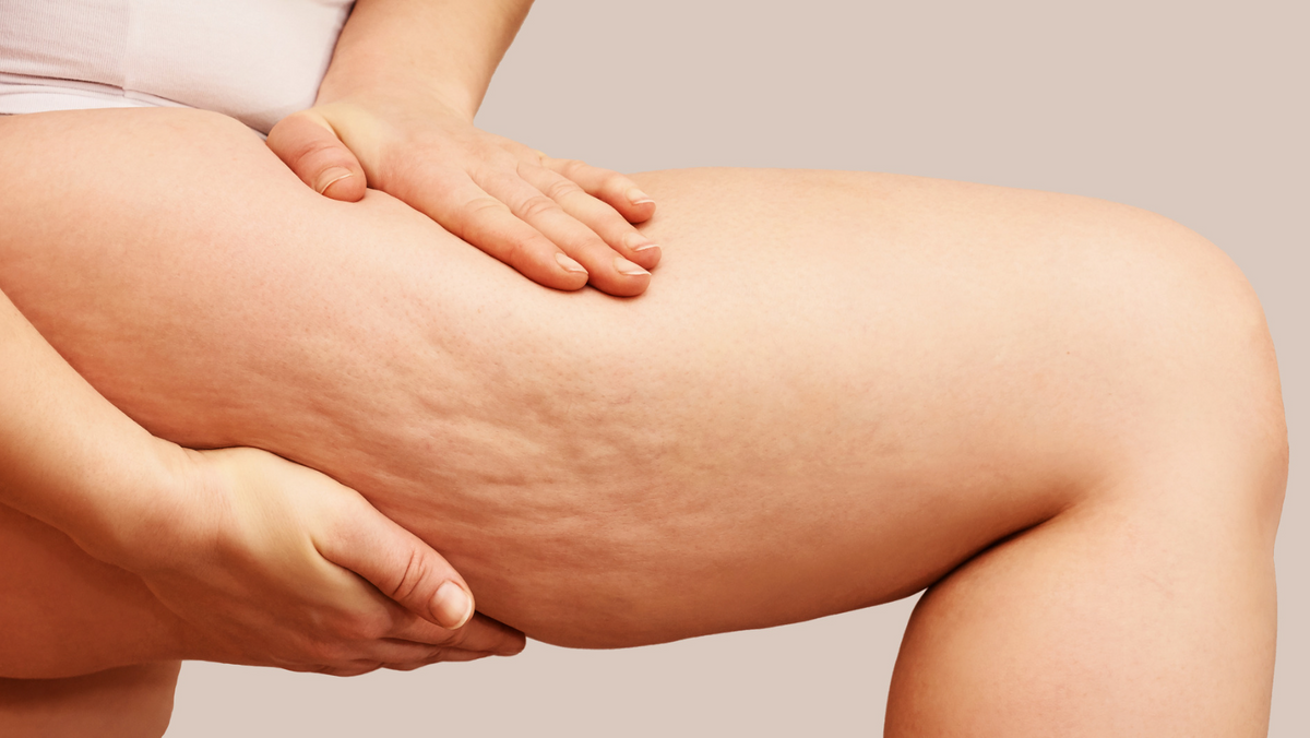 Rebooty: How To Treat Cellulite
